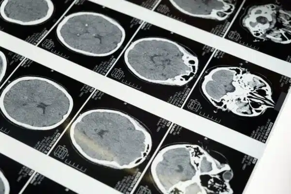 Améliorer la mémoire et la cognition des seniors : prévention et traitement à adopter