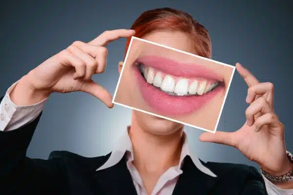 Les facettes dentaires : une solution pour avoir de belles dents