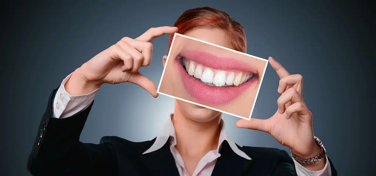 Les facettes dentaires : une solution pour avoir de belles dents